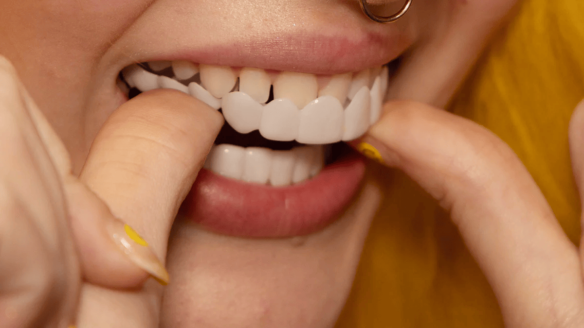Carillas Snap - On Smile Instantáneas y Reutilizables - VyFlair