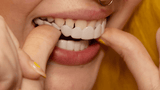 Carillas Snap - On Smile Instantáneas y Reutilizables - VyFlair