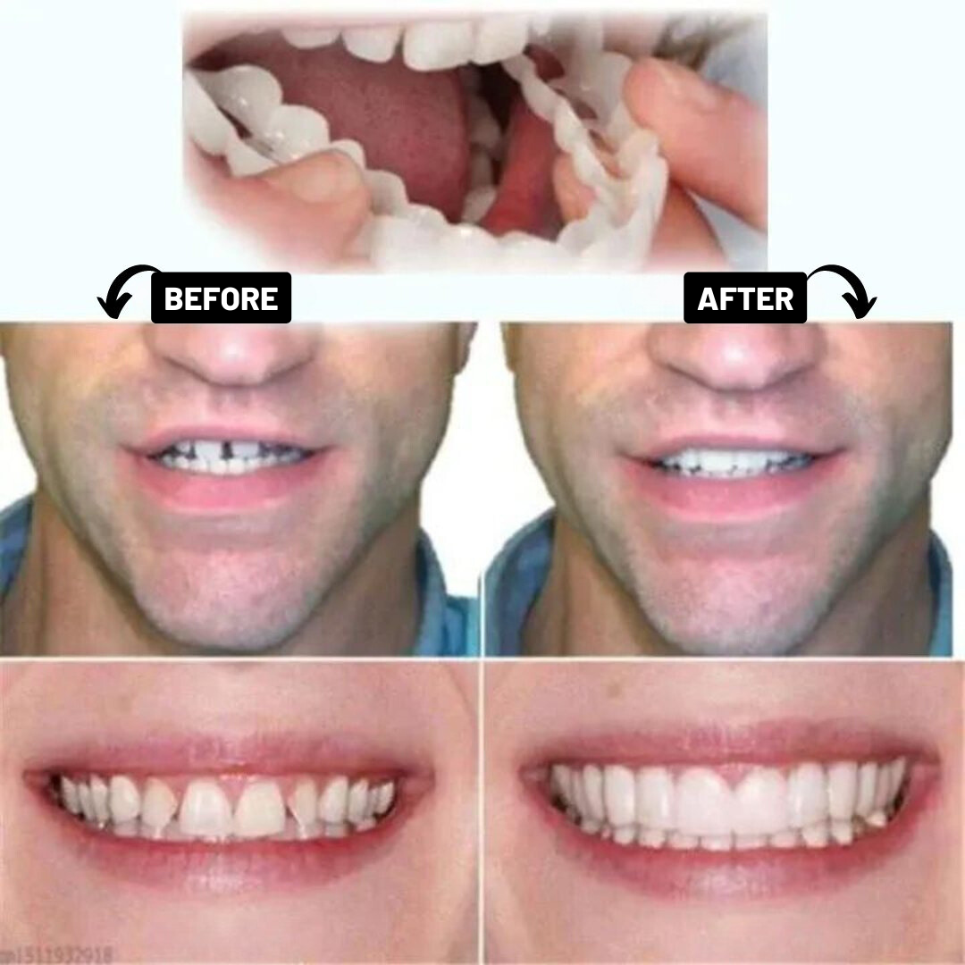 Prótesis Snap-on-dental | Ajustable-VyFlair