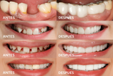 BrightBite Prótesis Dental Instantánea EasyClick