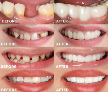 BrightBite - Prótesis Dental EasyClick